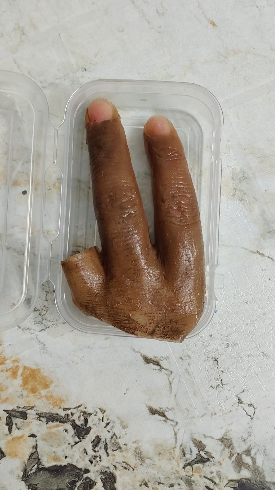 Silicone Partial Hand — silicone restoration work by Divine Artificial Limb Solutions