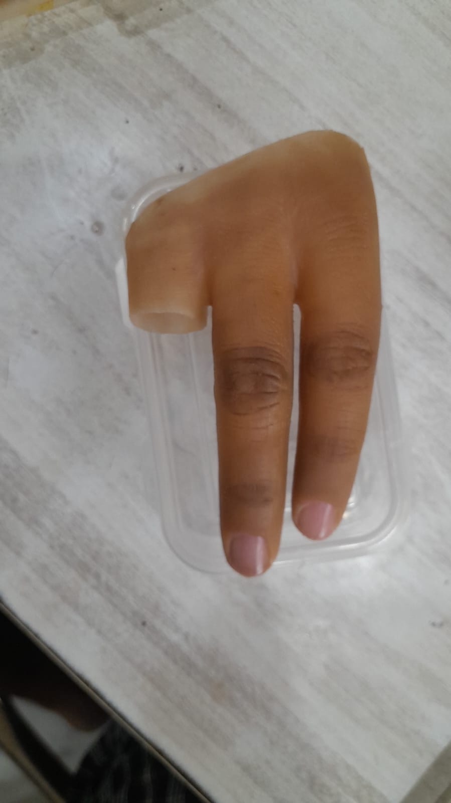 Silicone Partial Hand — silicone restoration work by Divine Artificial Limb Solutions