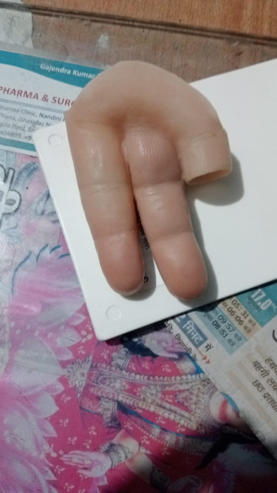 Silicone Partial Hand — silicone restoration work by Divine Artificial Limb Solutions