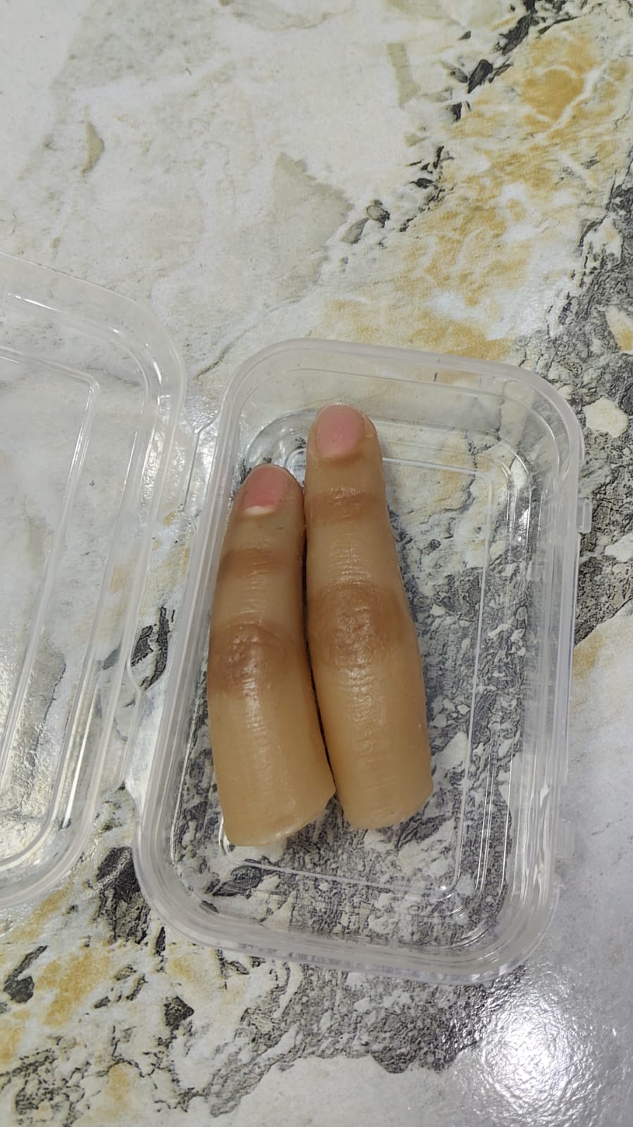 Silicone Finger Prosthesis — silicone restoration work by Divine Artificial Limb Solutions