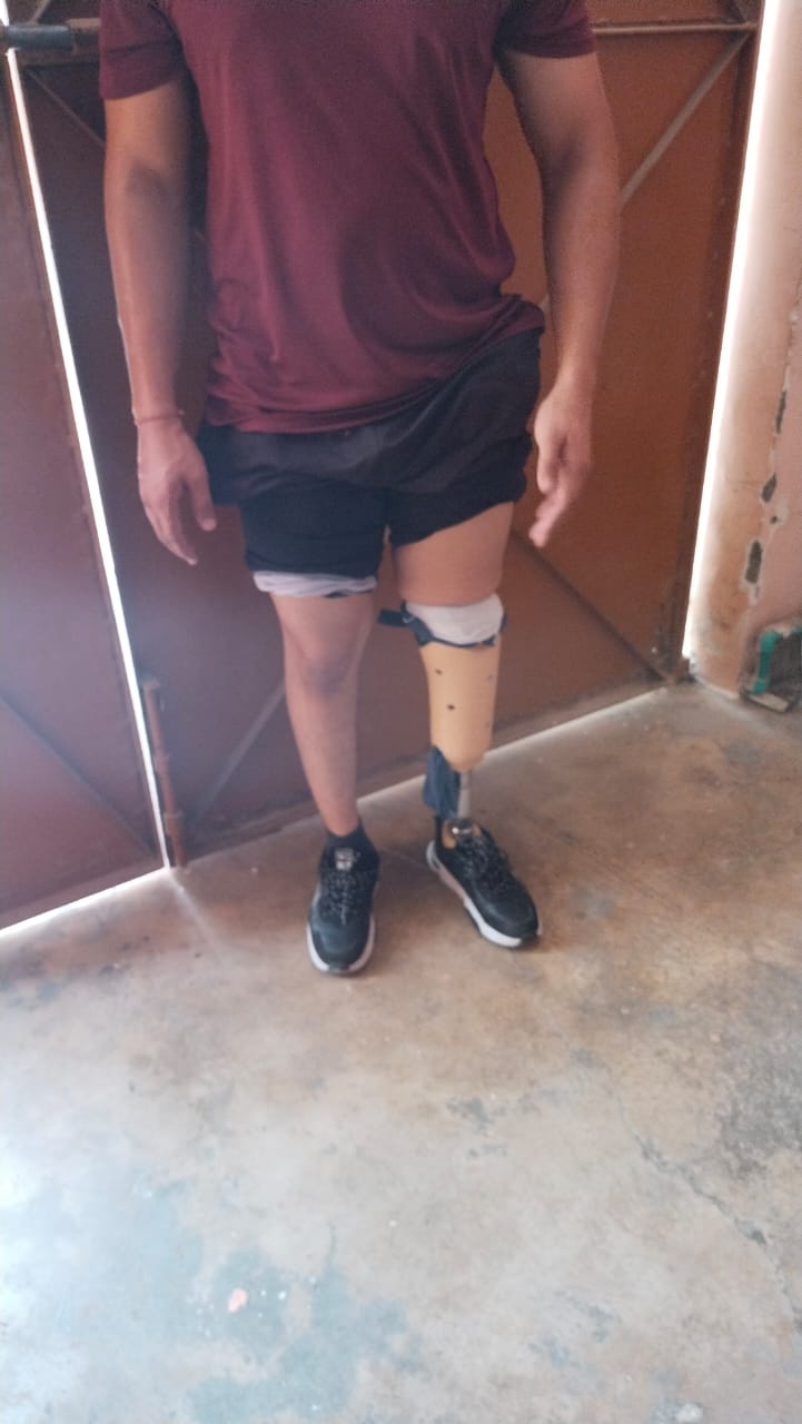 Below Knee Prosthesis — prosthetic work by Divine Artificial Limb Solutions