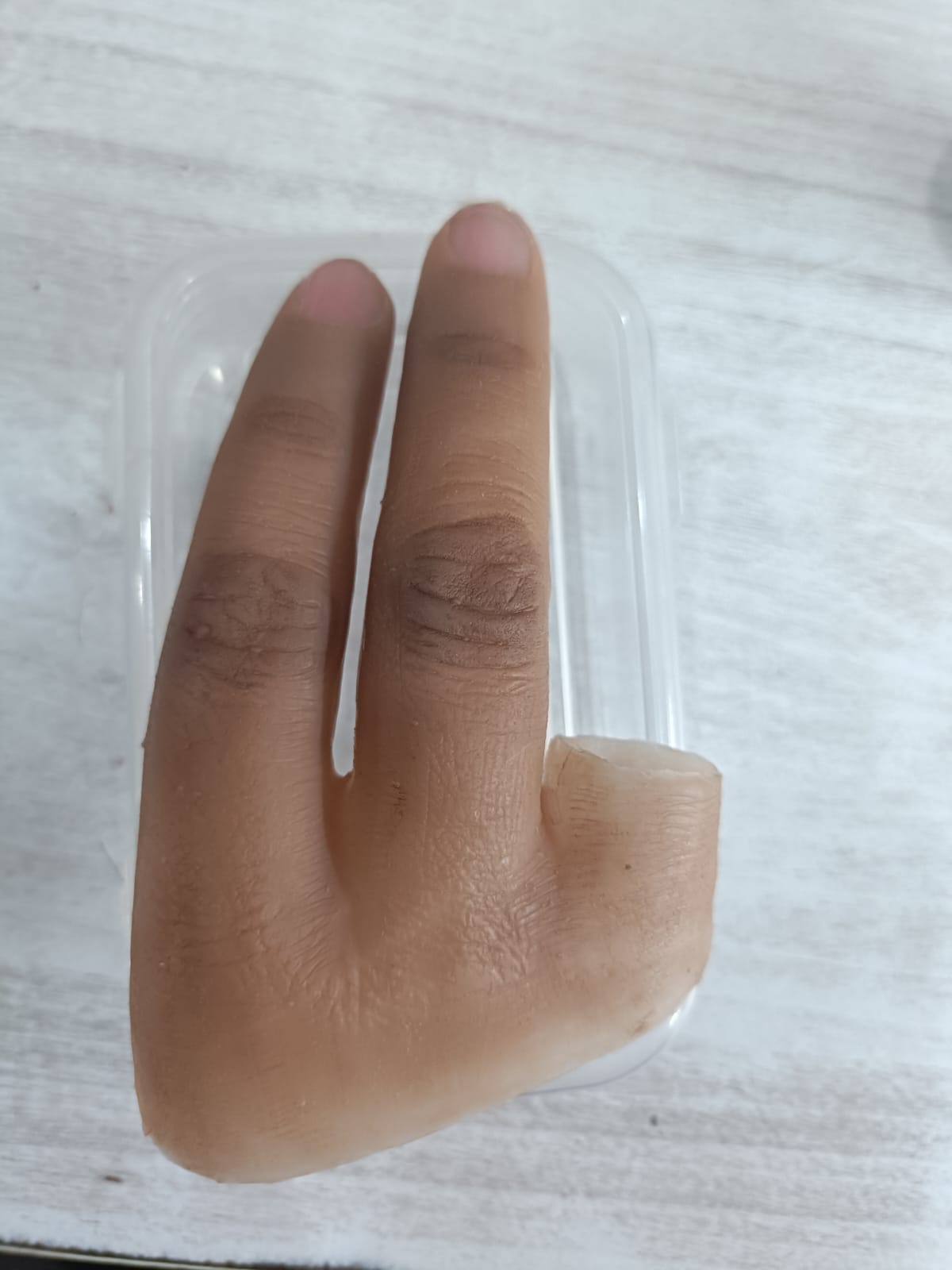 Silicone Partial Hand — silicone restoration work by Divine Artificial Limb Solutions