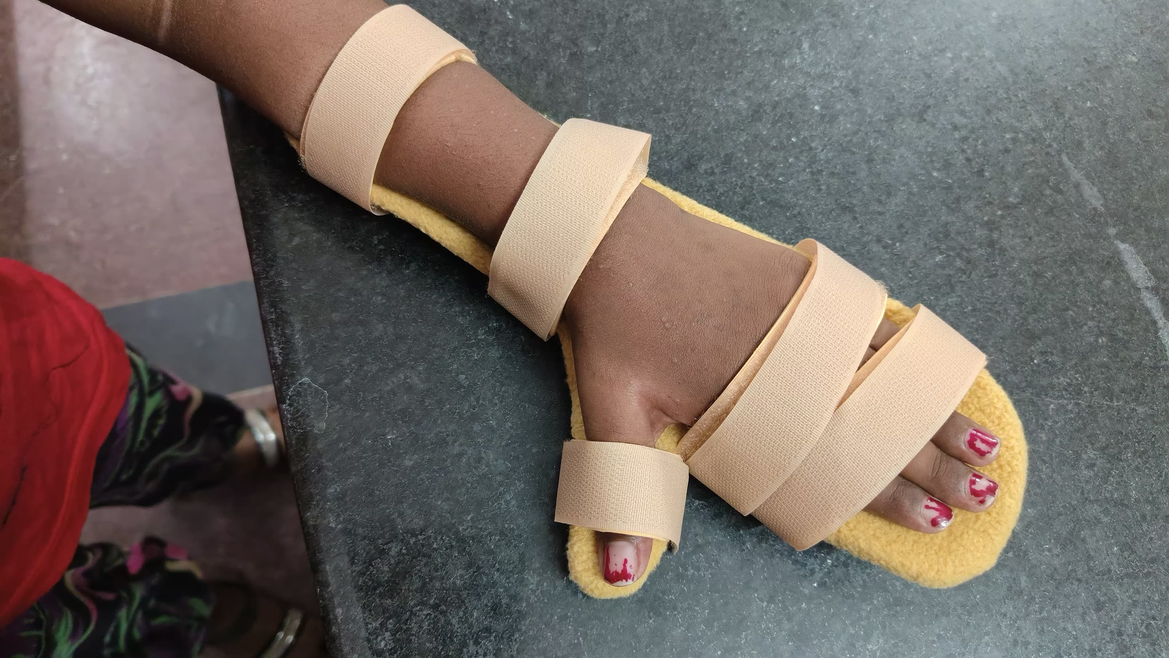Resting Hand Splint — orthotic work by Divine Artificial Limb Solutions