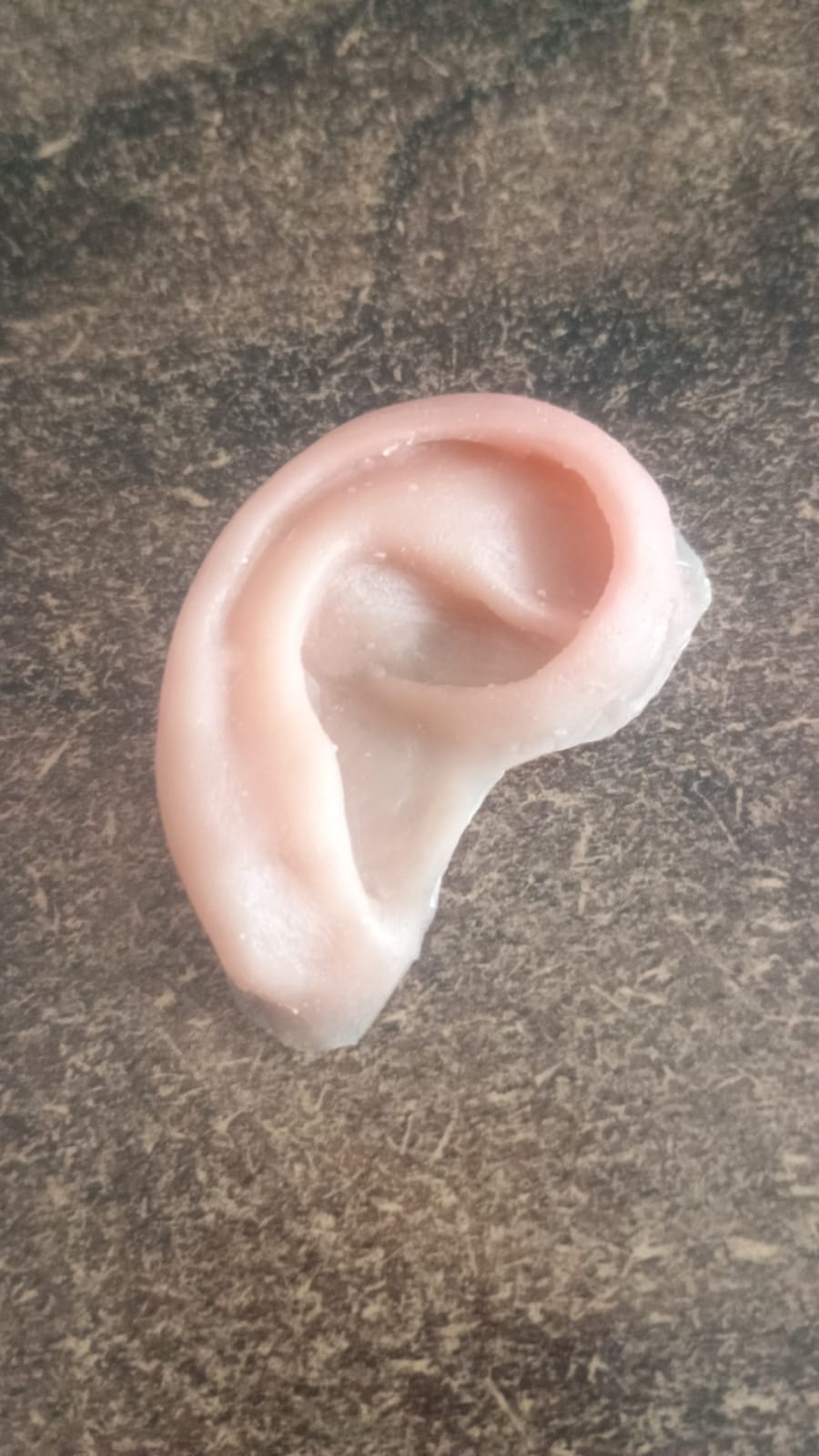 Silicone Ear Prosthesis — silicone restoration work by Divine Artificial Limb Solutions