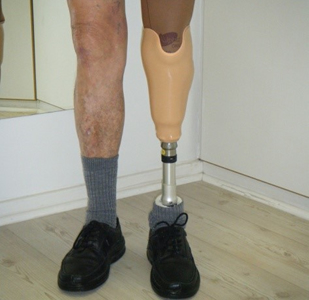 Below Knee Prosthesis — prosthetic work by Divine Artificial Limb Solutions