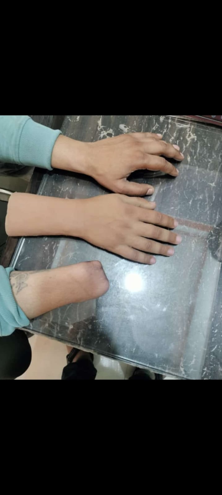Silicone Hand Prosthesis — silicone restoration work by Divine Artificial Limb Solutions