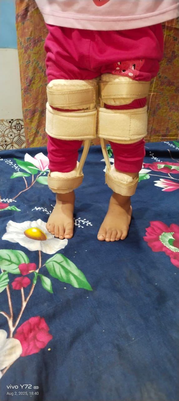 KAFO — orthotic work by Divine Artificial Limb Solutions
