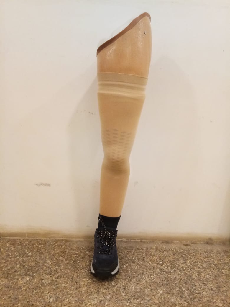 Above Knee Prosthesis — prosthetic work by Divine Artificial Limb Solutions