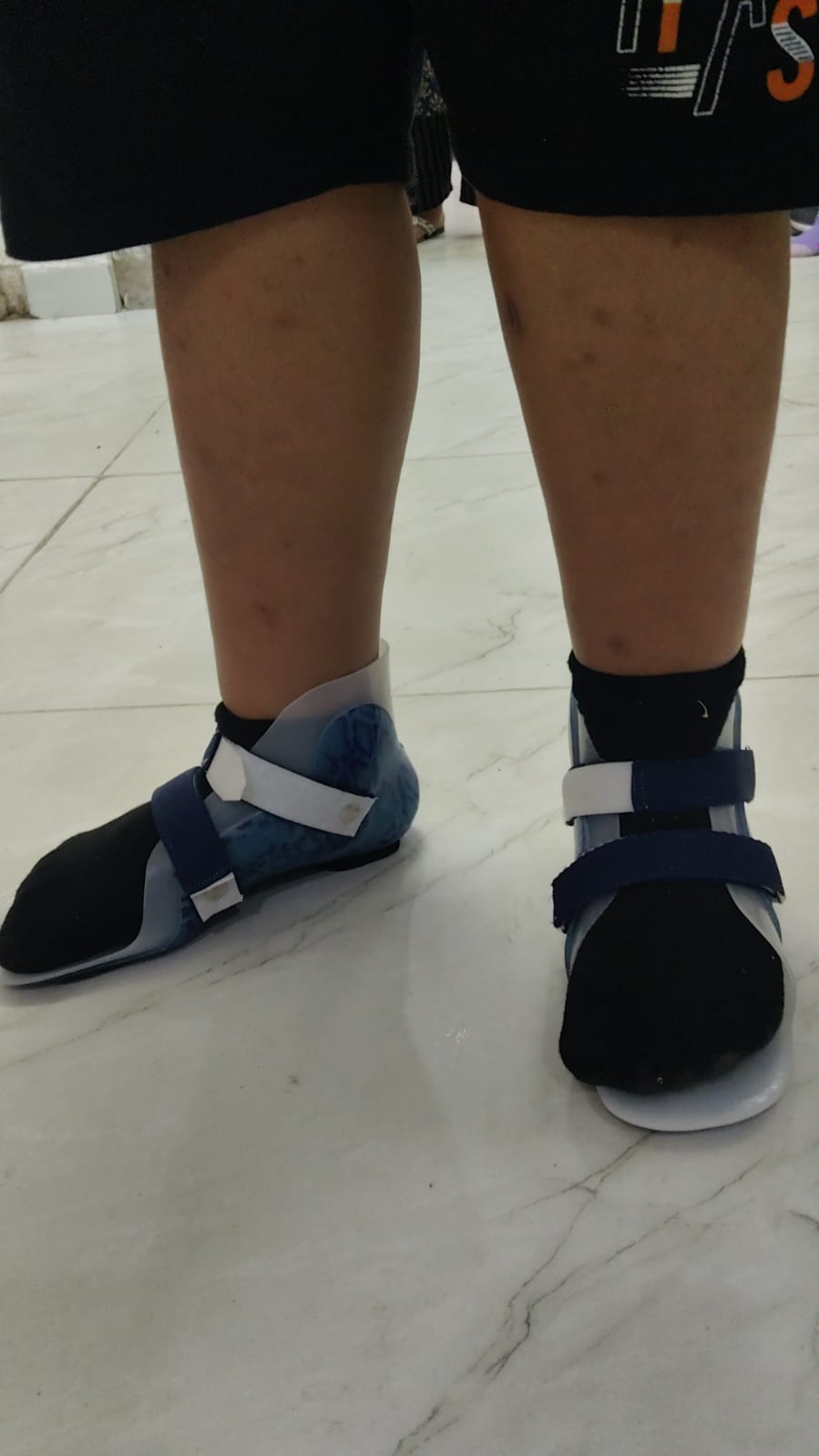 Ankle Foot Orthosis (AFO) — orthotic work by Divine Artificial Limb Solutions