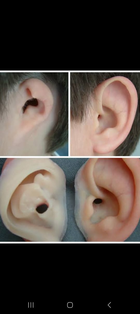 Silicone Ear Prosthesis — silicone restoration work by Divine Artificial Limb Solutions