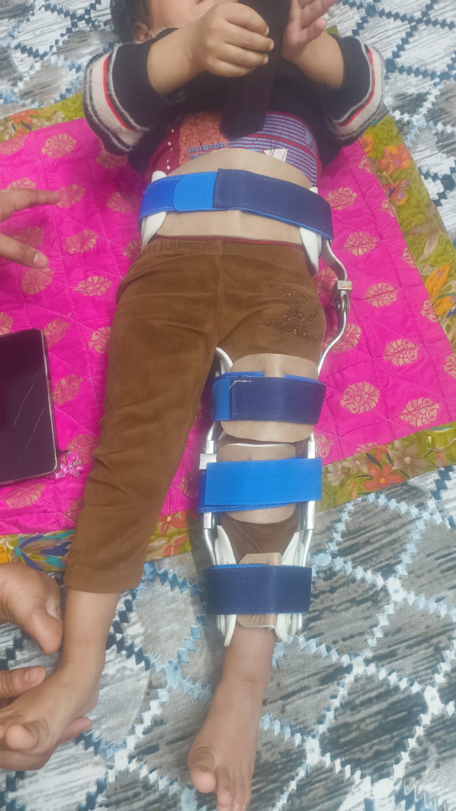 KAFO — orthotic work by Divine Artificial Limb Solutions