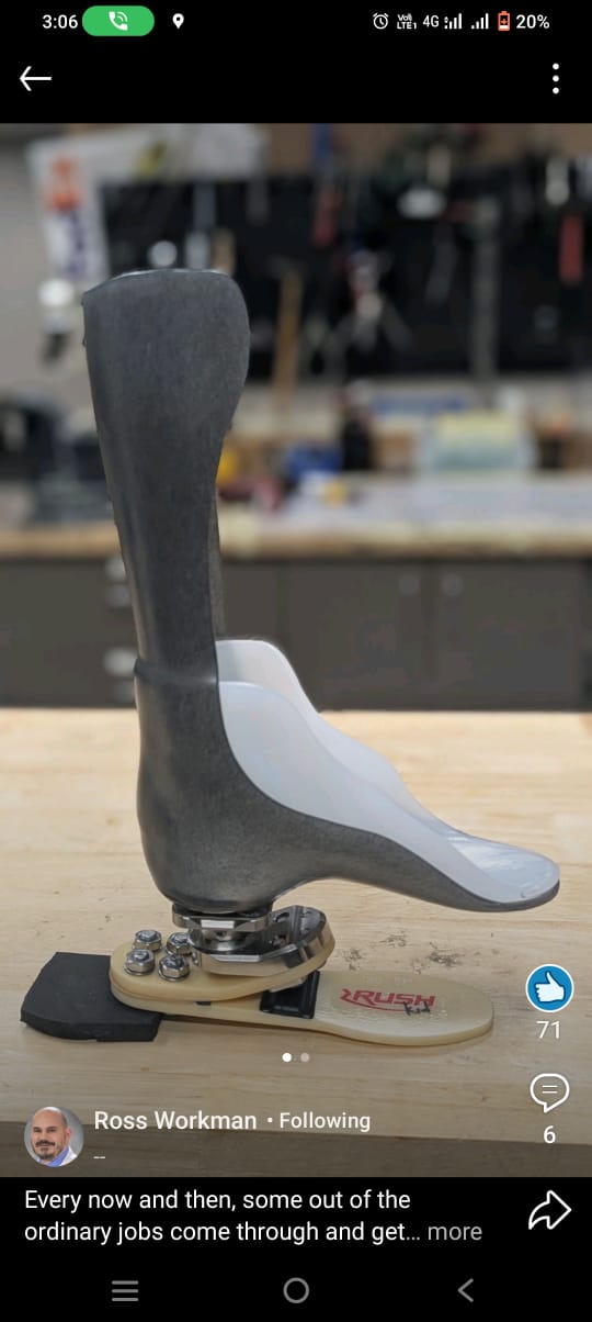 Partial Foot Prosthesis — prosthetic work by Divine Artificial Limb Solutions