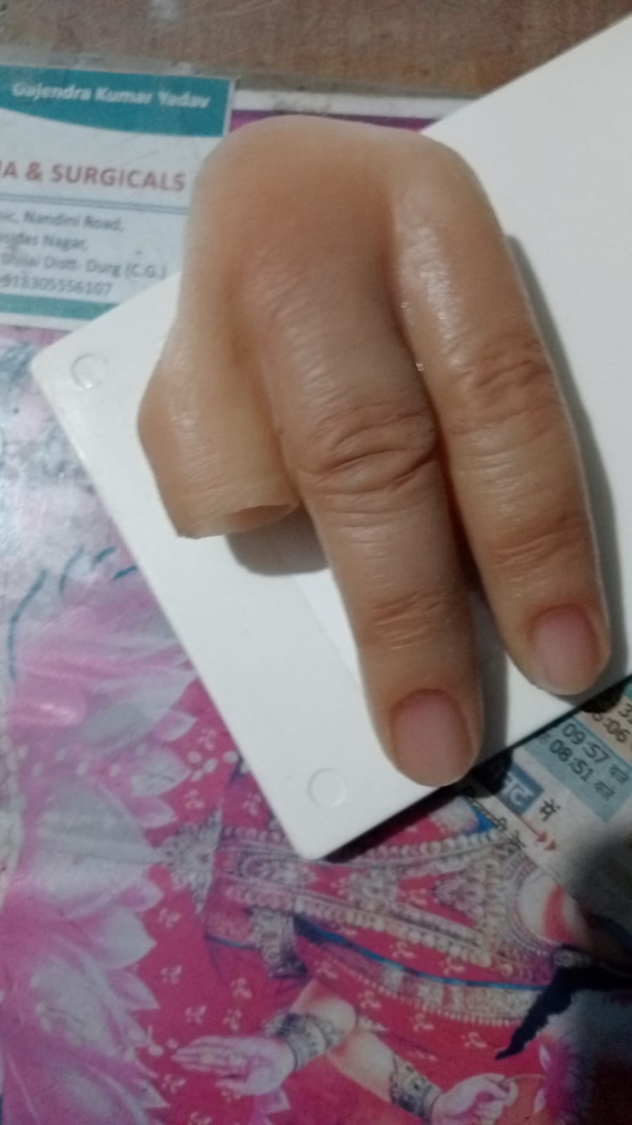 Silicone Partial Hand — silicone restoration work by Divine Artificial Limb Solutions