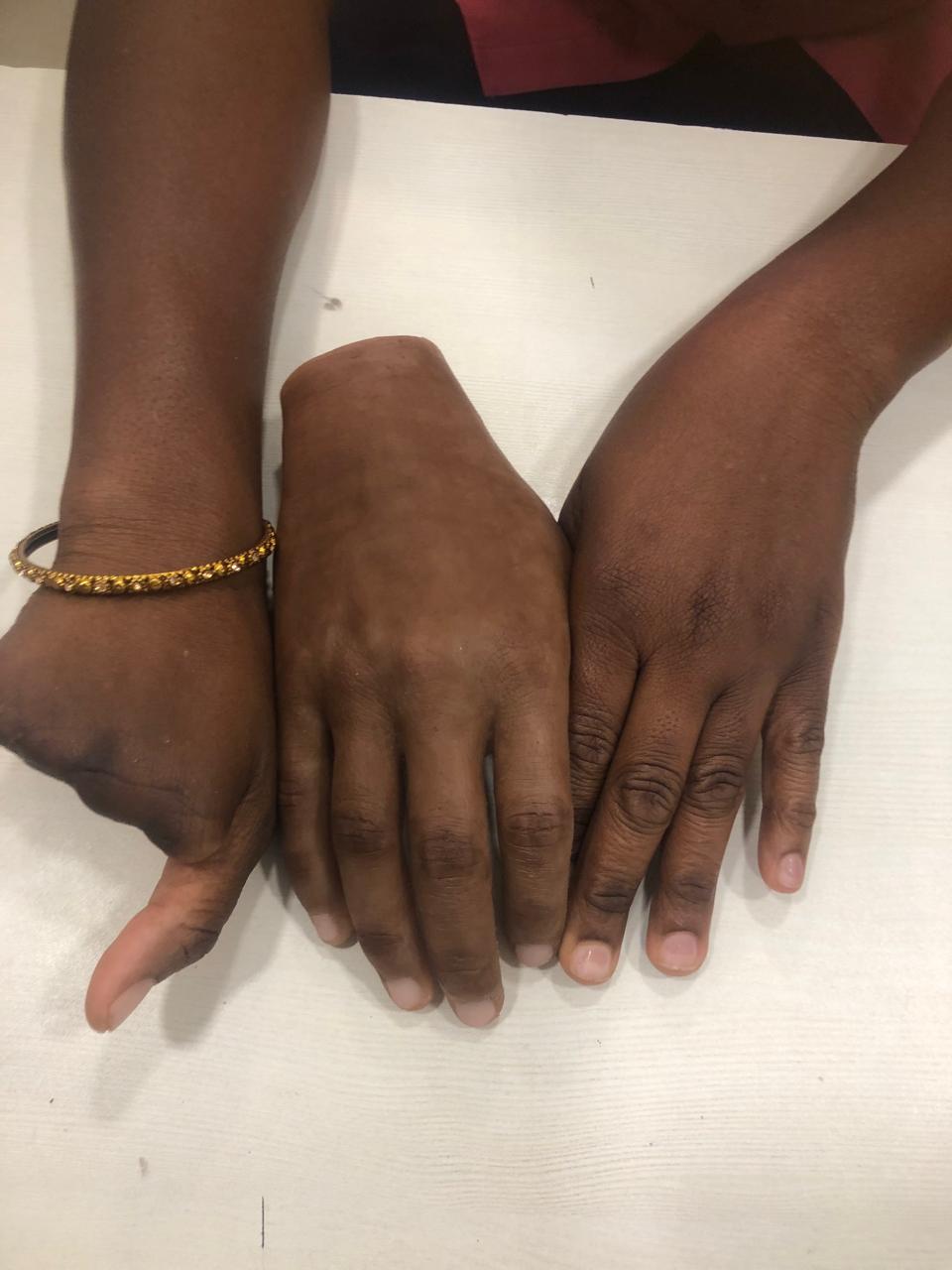 Silicone Partial Hand — silicone restoration work by Divine Artificial Limb Solutions