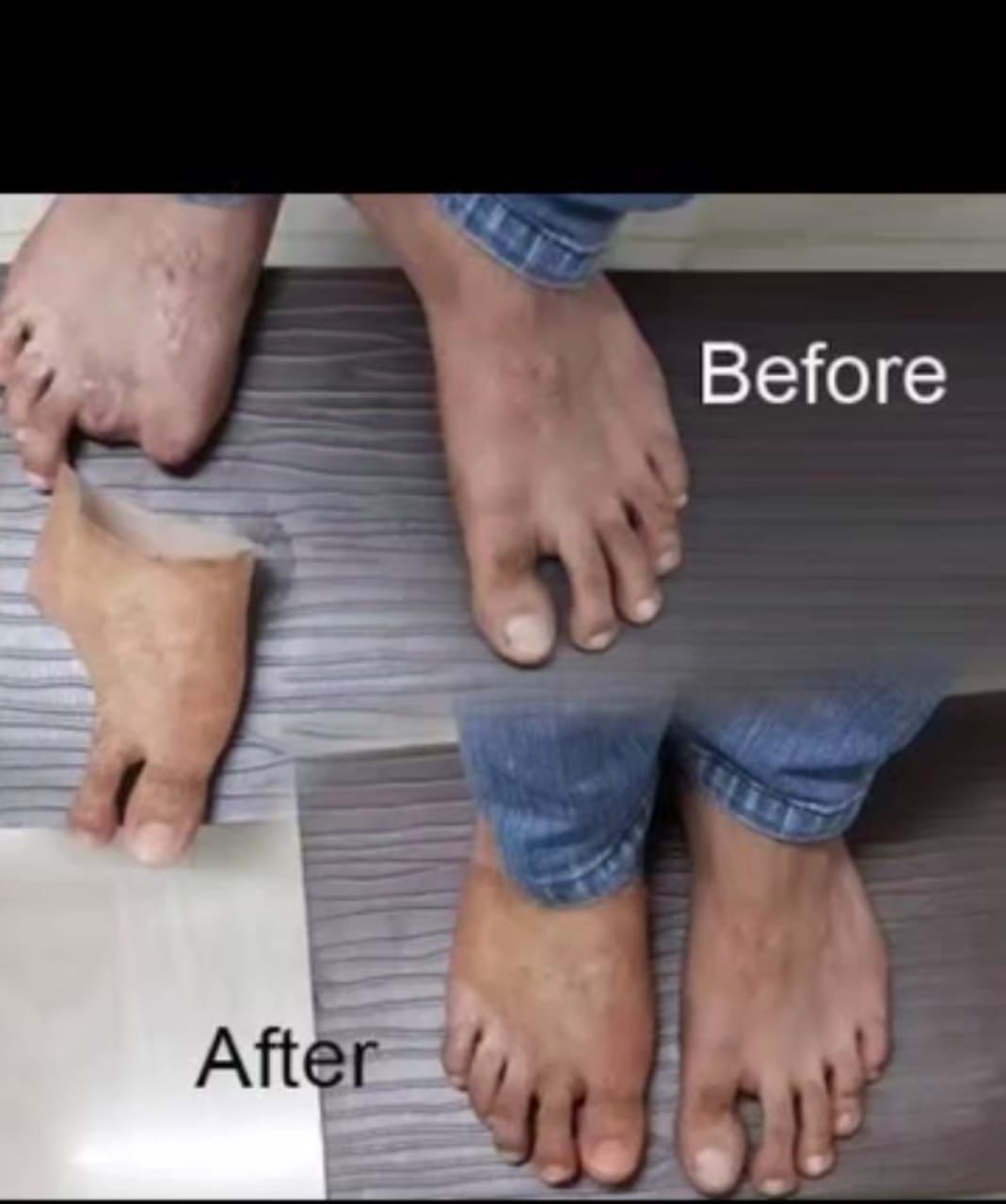 Silicone Partial Foot — silicone restoration work by Divine Artificial Limb Solutions