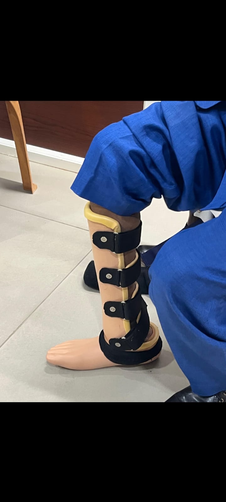 Knee Disarticulation Prosthesis — prosthetic work by Divine Artificial Limb Solutions
