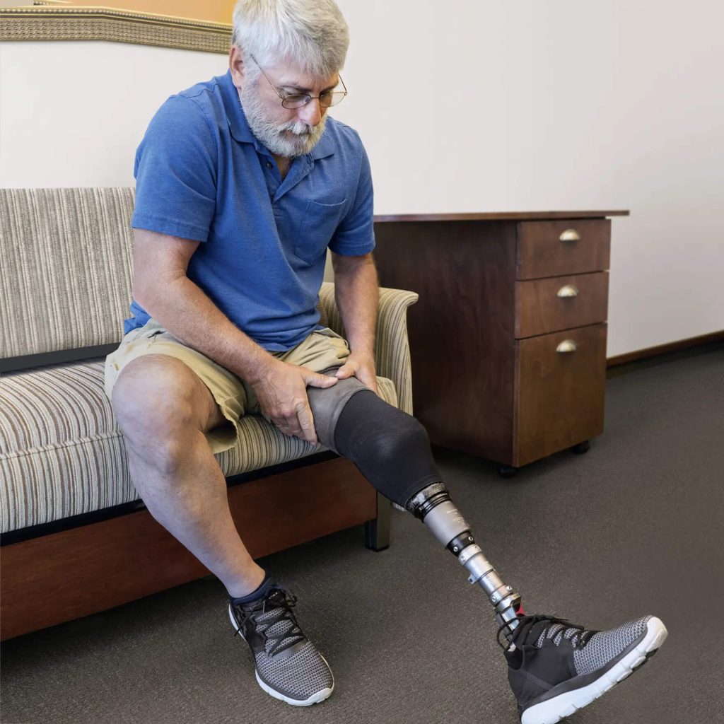 Below Knee Prosthesis — prosthetic work by Divine Artificial Limb Solutions