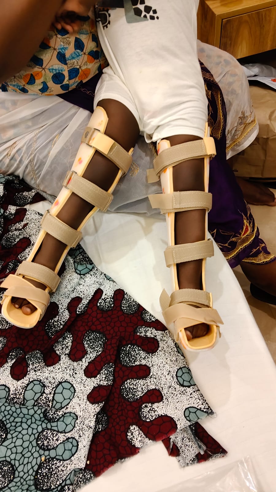 KAFO — orthotic work by Divine Artificial Limb Solutions