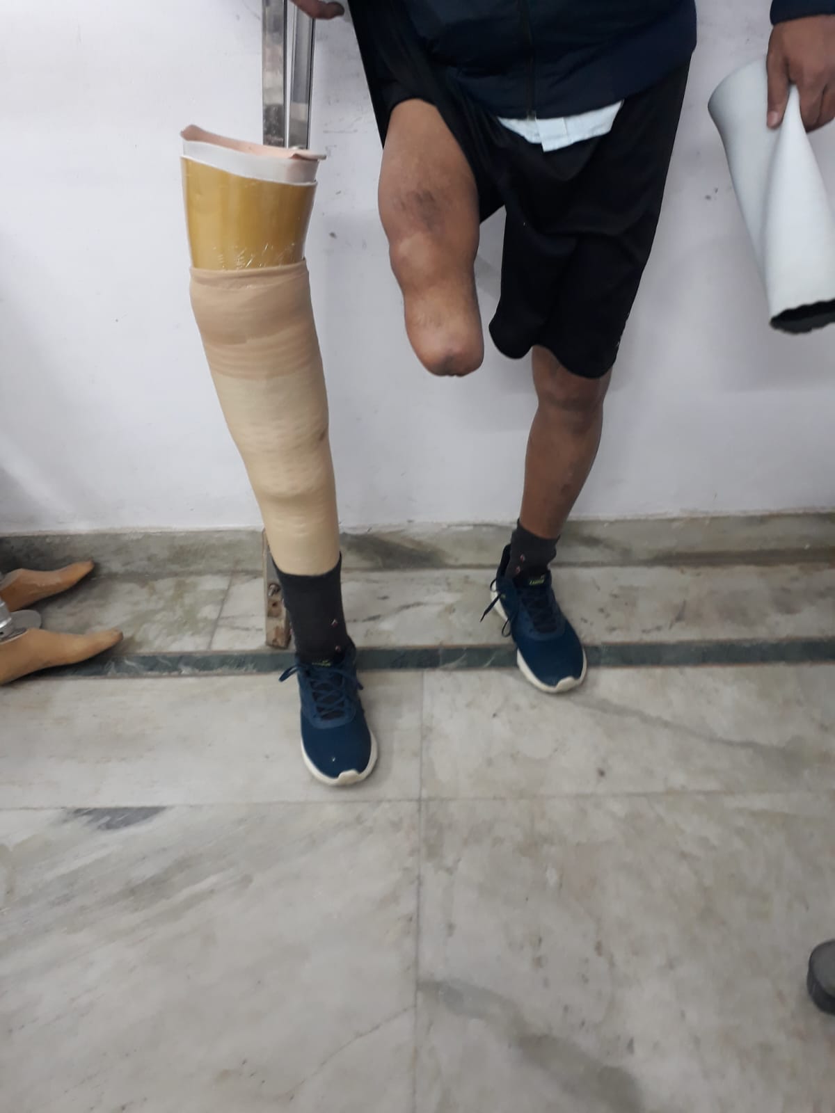 Below Knee Prosthesis — prosthetic work by Divine Artificial Limb Solutions