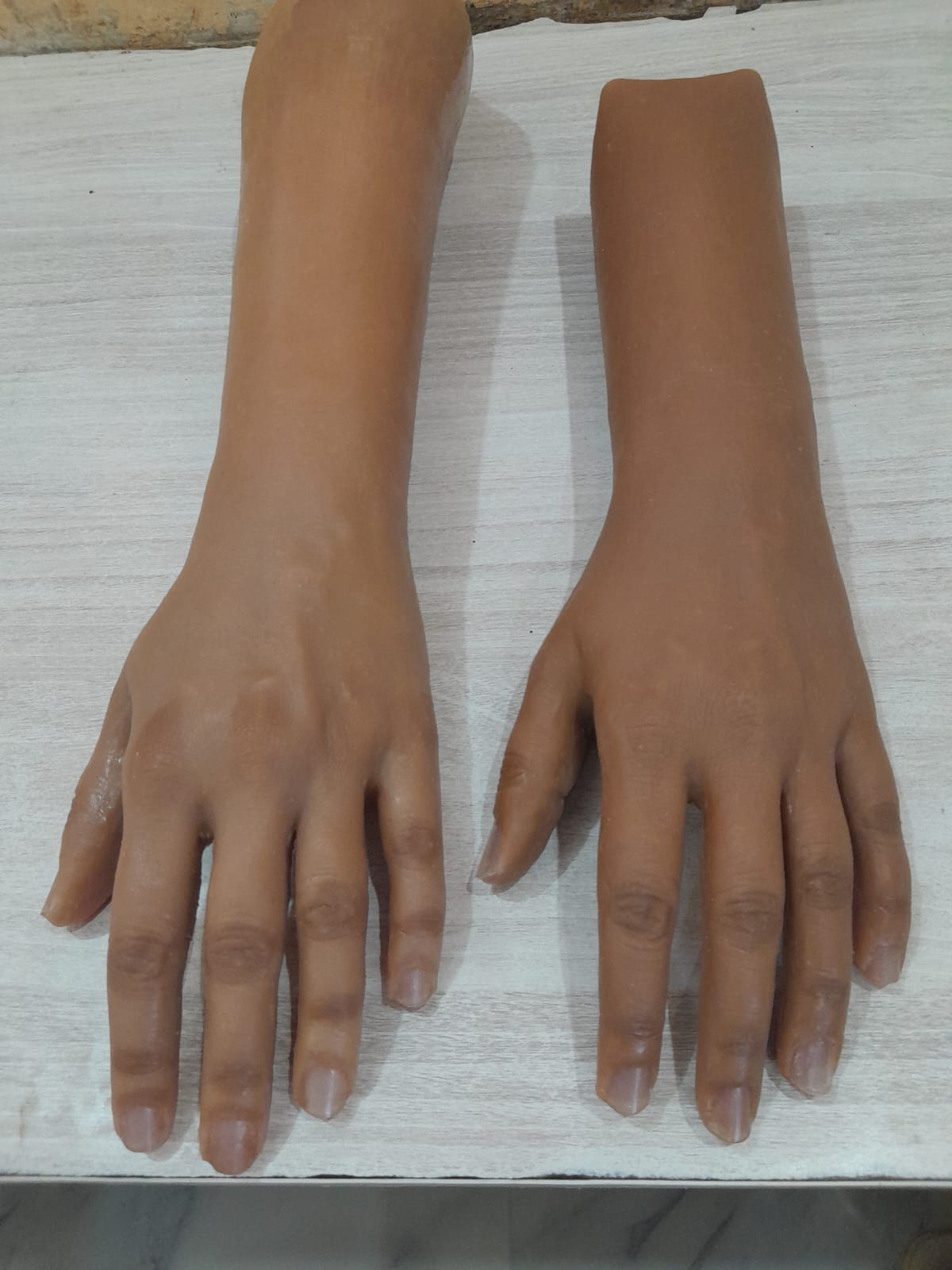 Silicone Hand Prosthesis — silicone restoration work by Divine Artificial Limb Solutions