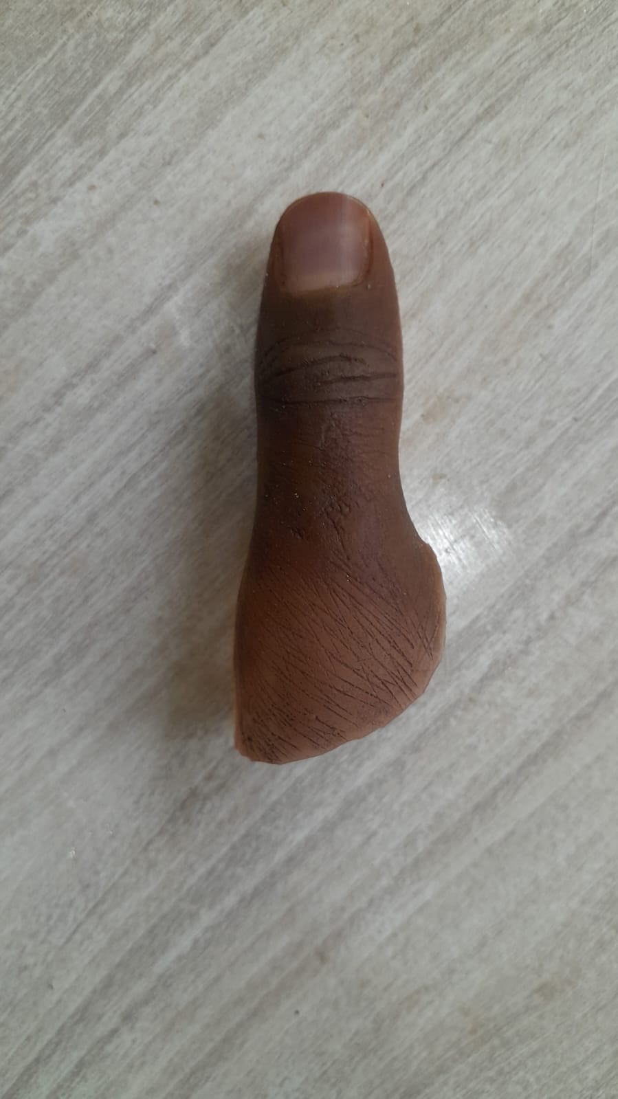 Silicone Finger Prosthesis — silicone restoration work by Divine Artificial Limb Solutions
