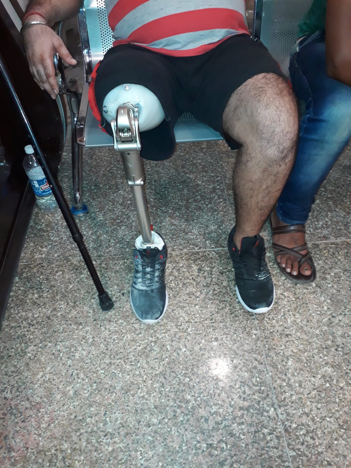 Above Knee Prosthesis — prosthetic work by Divine Artificial Limb Solutions
