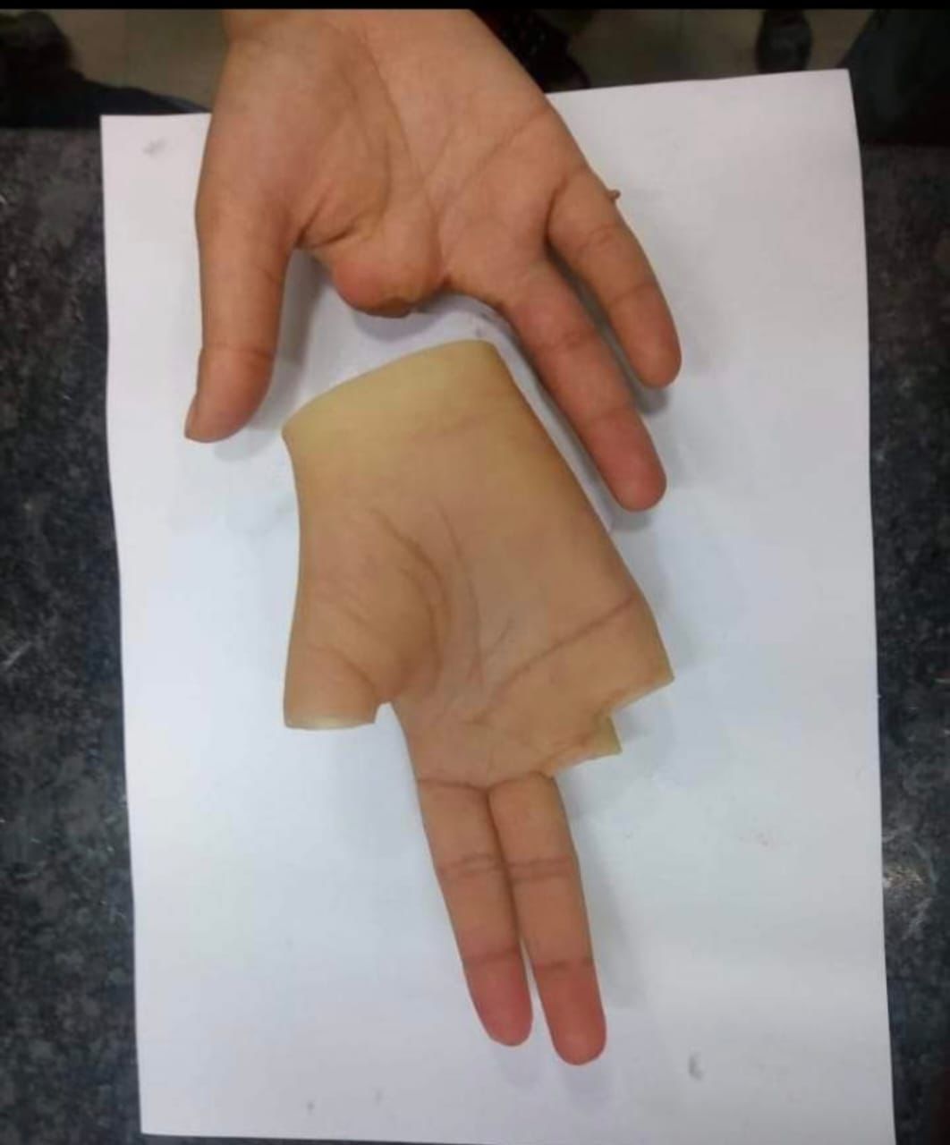 Silicone Partial Hand — silicone restoration work by Divine Artificial Limb Solutions