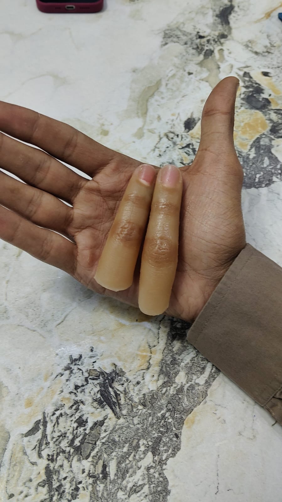Silicone Finger Prosthesis — silicone restoration work by Divine Artificial Limb Solutions
