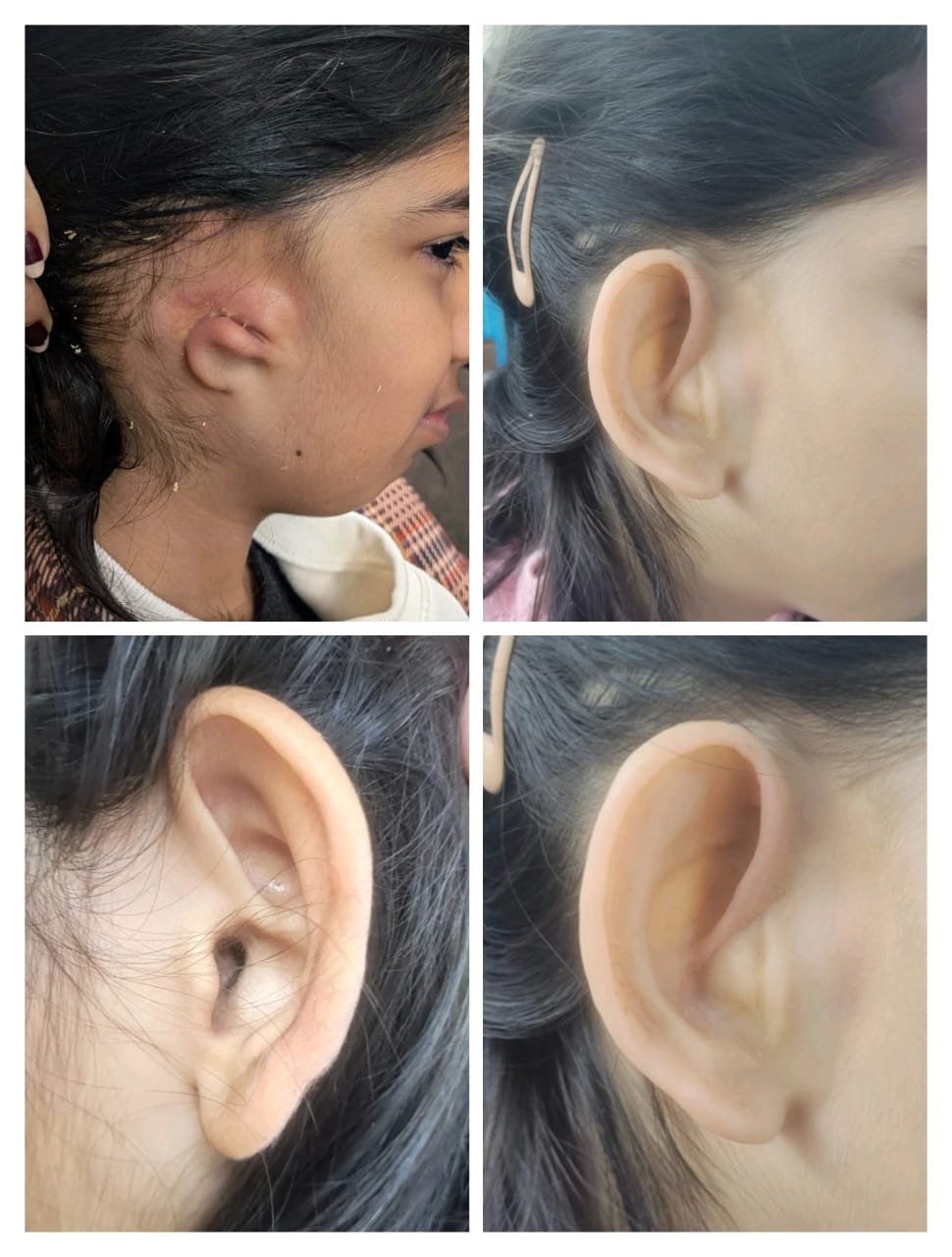 Silicone Ear Prosthesis — silicone restoration work by Divine Artificial Limb Solutions