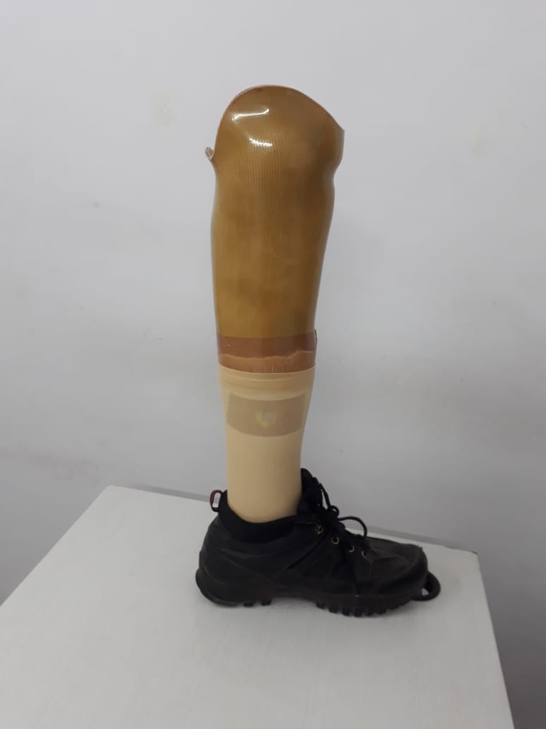 Below Knee Prosthesis — prosthetic work by Divine Artificial Limb Solutions