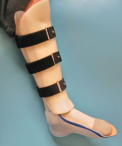 Solid AFO — orthotic work by Divine Artificial Limb Solutions