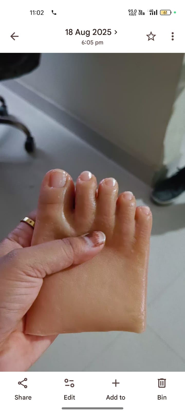 Silicone Partial Foot — silicone restoration work by Divine Artificial Limb Solutions