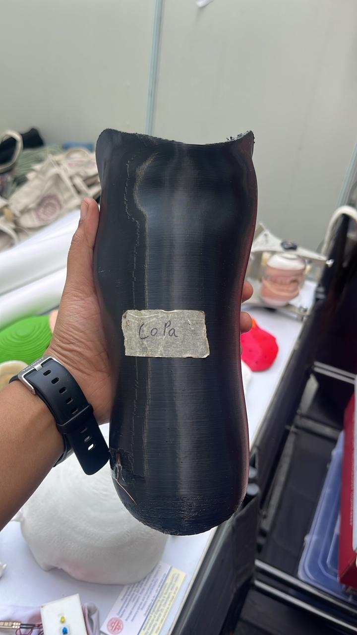 PP Socket — prosthetic work by Divine Artificial Limb Solutions