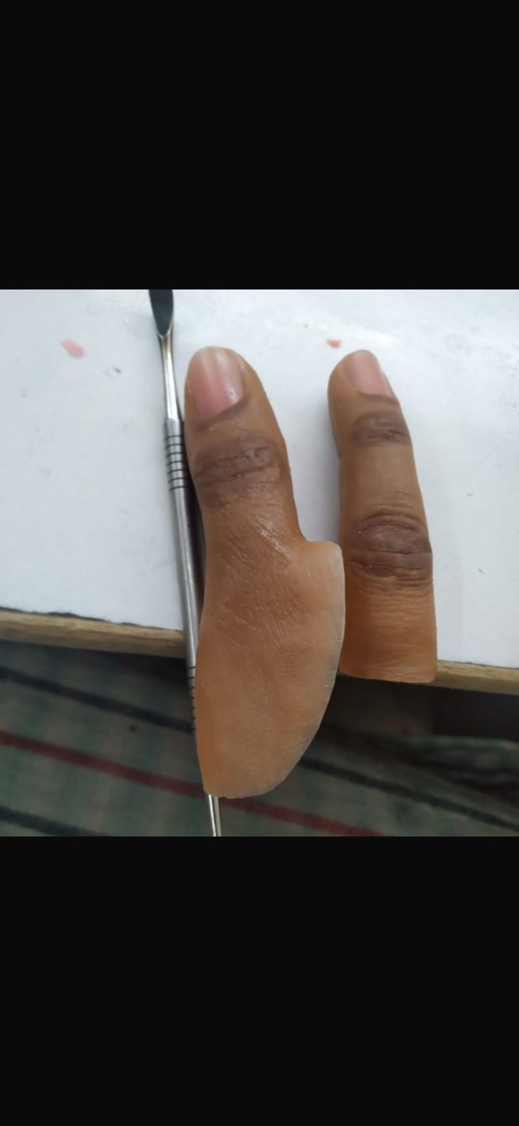 Silicone Partial Hand — silicone restoration work by Divine Artificial Limb Solutions