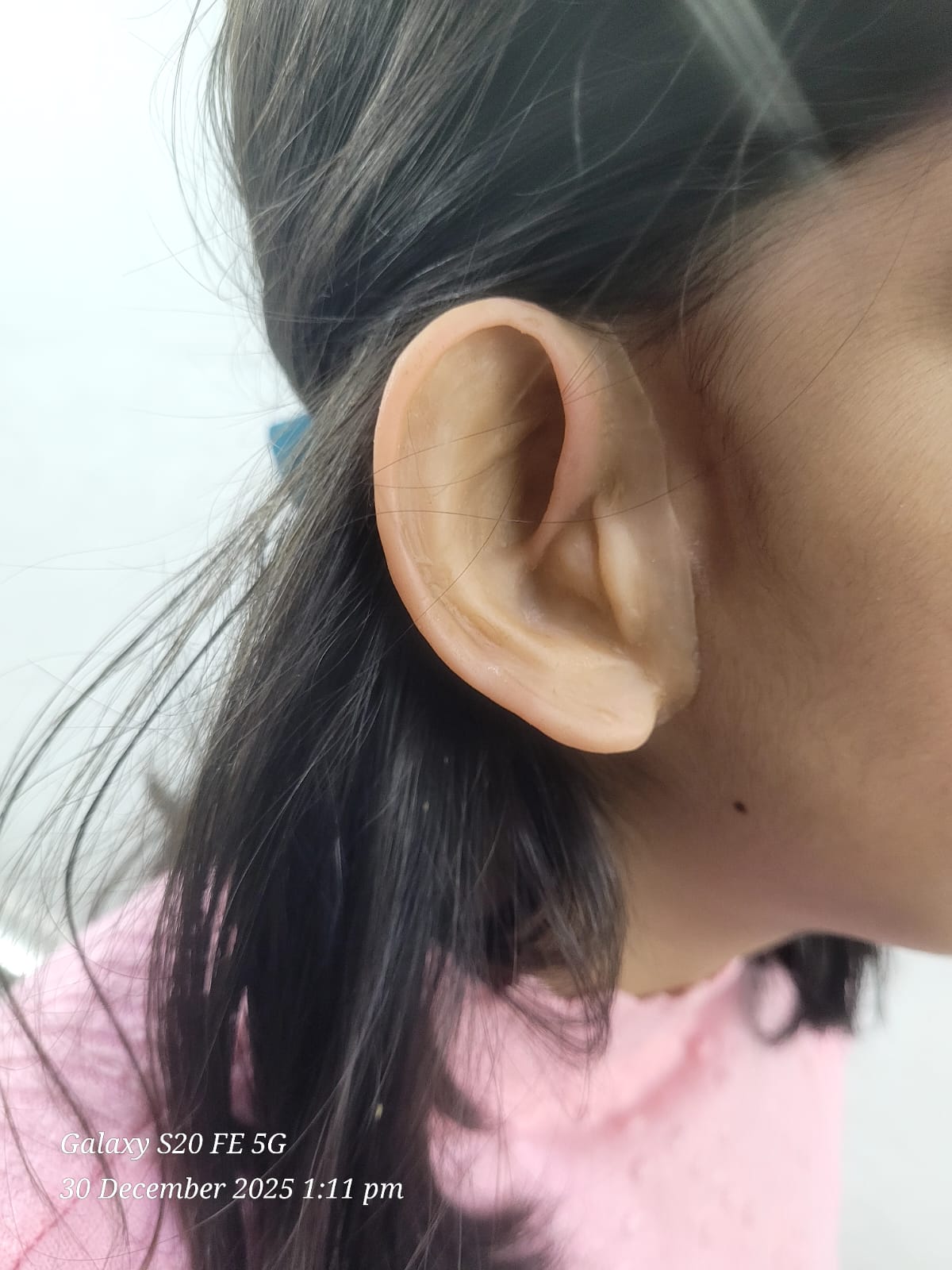 Silicone Ear Prosthesis — silicone restoration work by Divine Artificial Limb Solutions